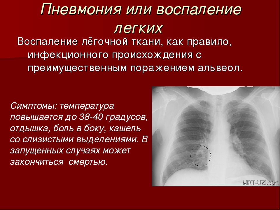 Пневмония симптомы у взрослых. Пневмония симптомы. Воспаление лёгких симптомы у взрослых без температуры.