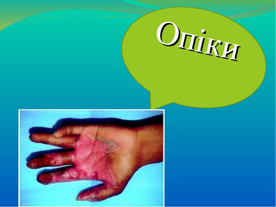 "Опіки"
