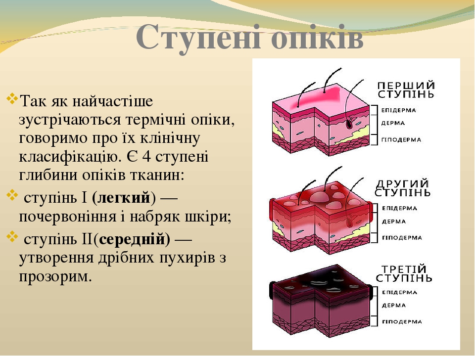 "Опіки"