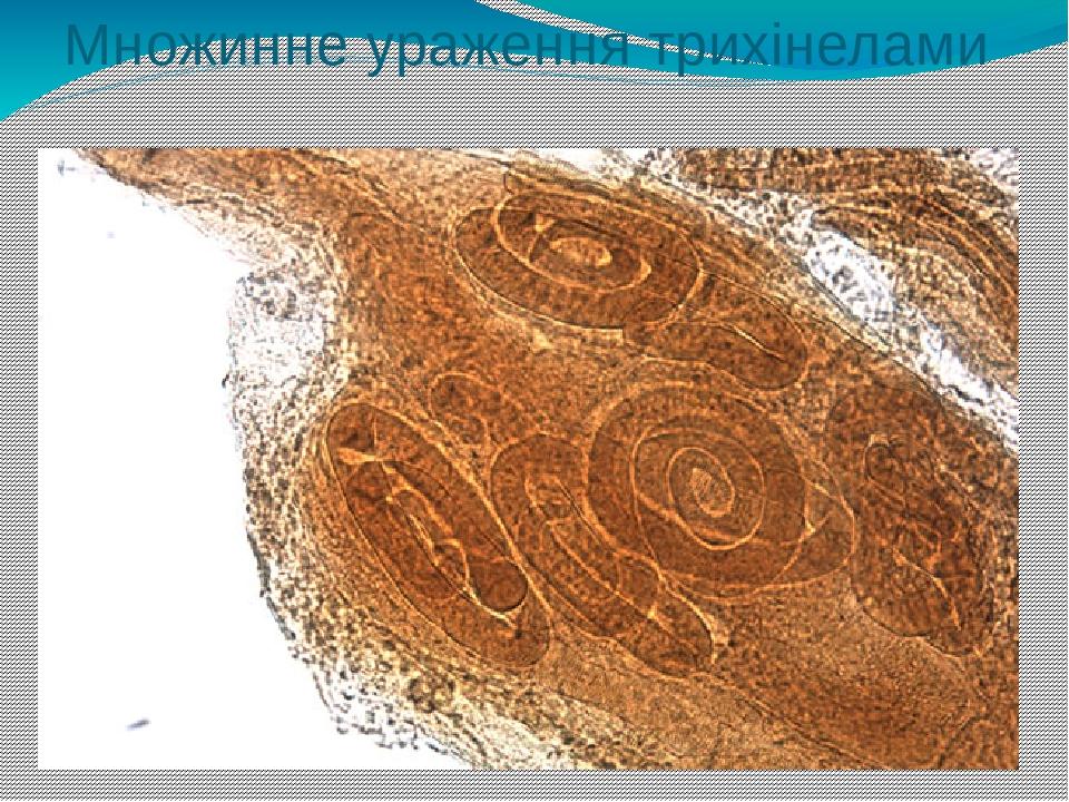 Множинне ураження трихінелами