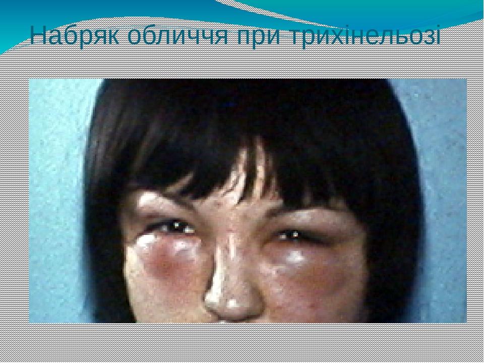 Набряк обличчя при трихінельозі