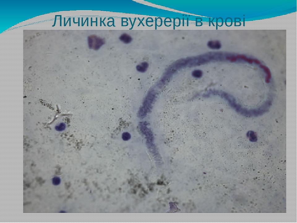 Личинка вухерерії в крові