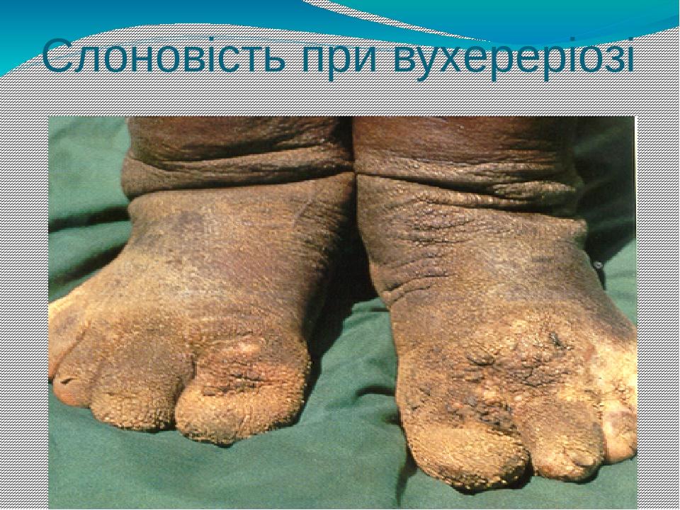 Слоновість при вухереріозі