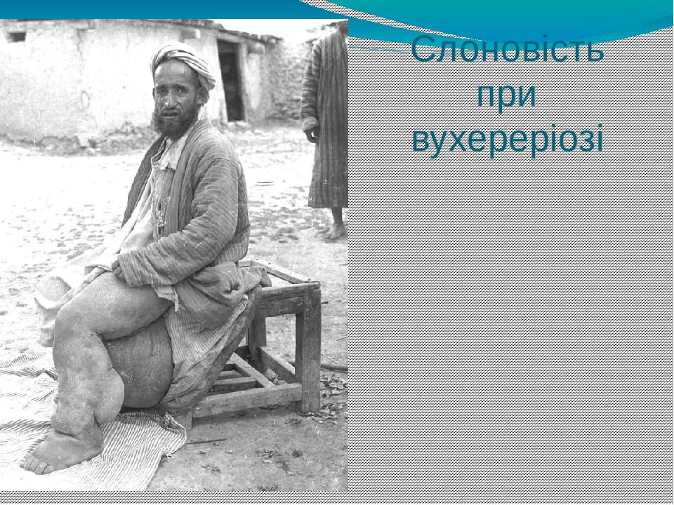 Слоновість при вухереріозі