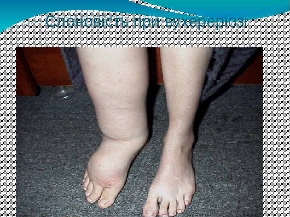 Слоновість при вухереріозі