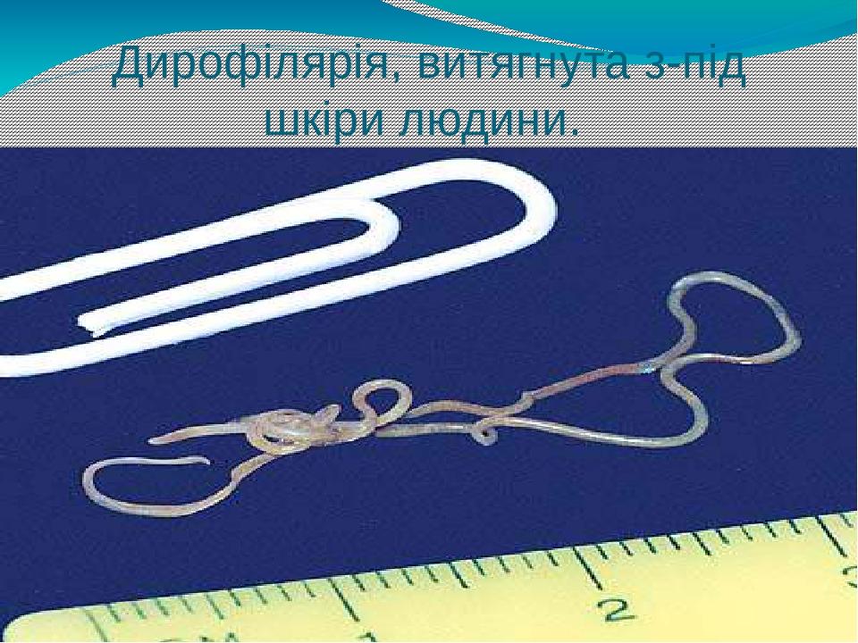 Дирофілярія, витягнута з-під шкіри людини.