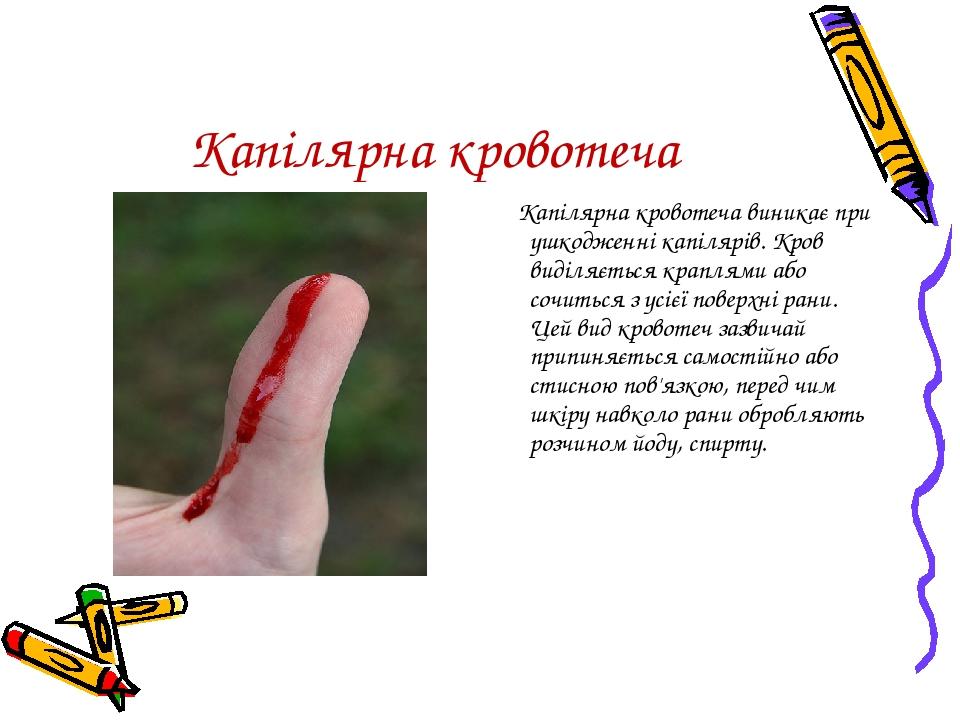 Капілярна кровотеча Капілярна кровотеча виникає при ушкодженні капілярів. Кров виділяється краплями або сочиться з усієї поверхні рани. Цей вид кро...