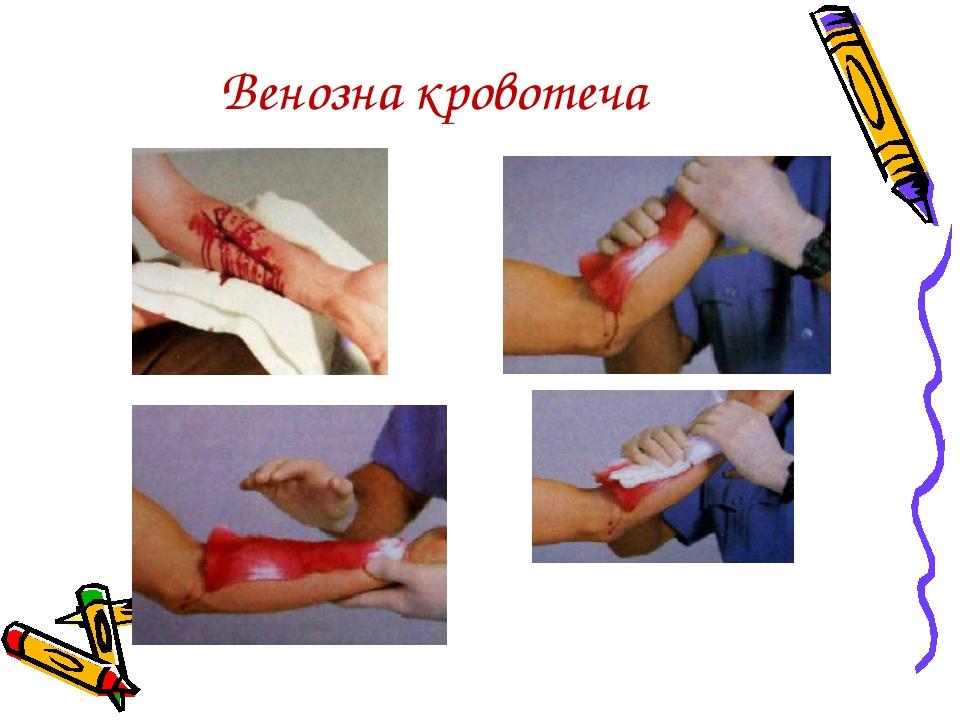Венозна кровотеча