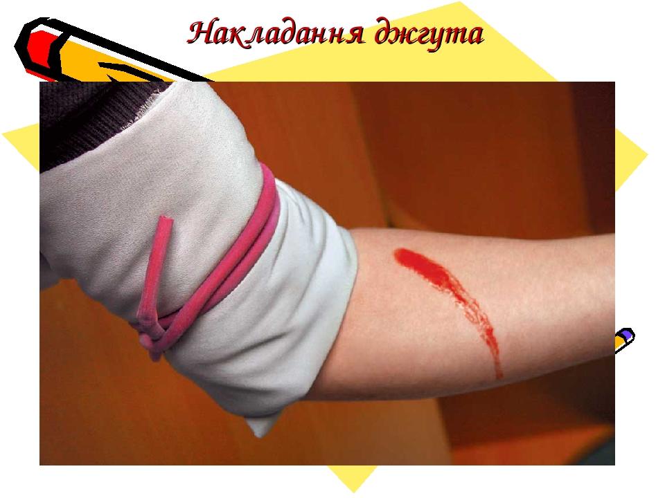Накладання джгута